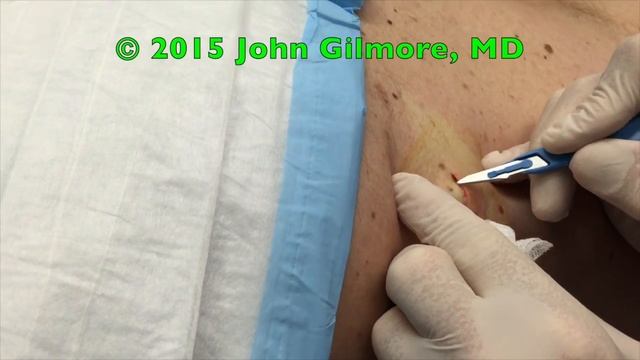 Gambit Part 1,  Abscess/Cyst Treatment,  Dr. Gilmore's Birthday!