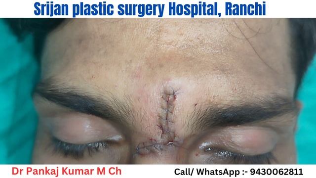 Scar!! What to do?? | Scar revision surgery| Best scar treatment| How to remove scar #scar