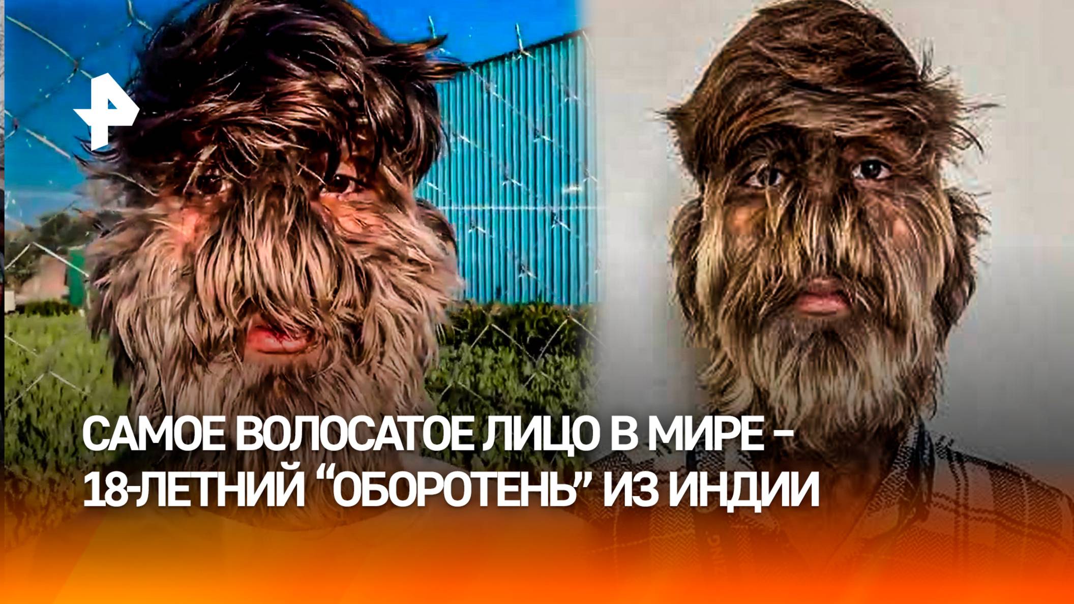 Волосы на 95% лица: 18-летний "оборотень" покорил соцсети и попал в Книгу рекордов Гиннесса