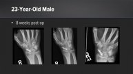 Using BioSurge™ Cell and Bone Graft Processing System