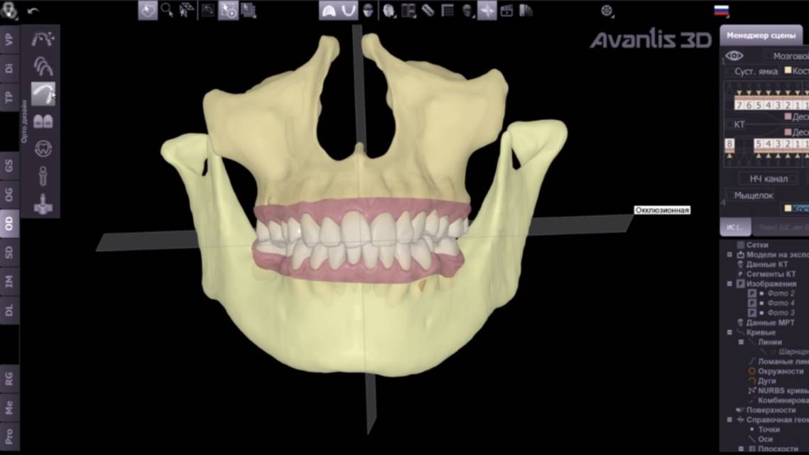 Программа Авантис 3D и подготовка моделей для производства элайнеров