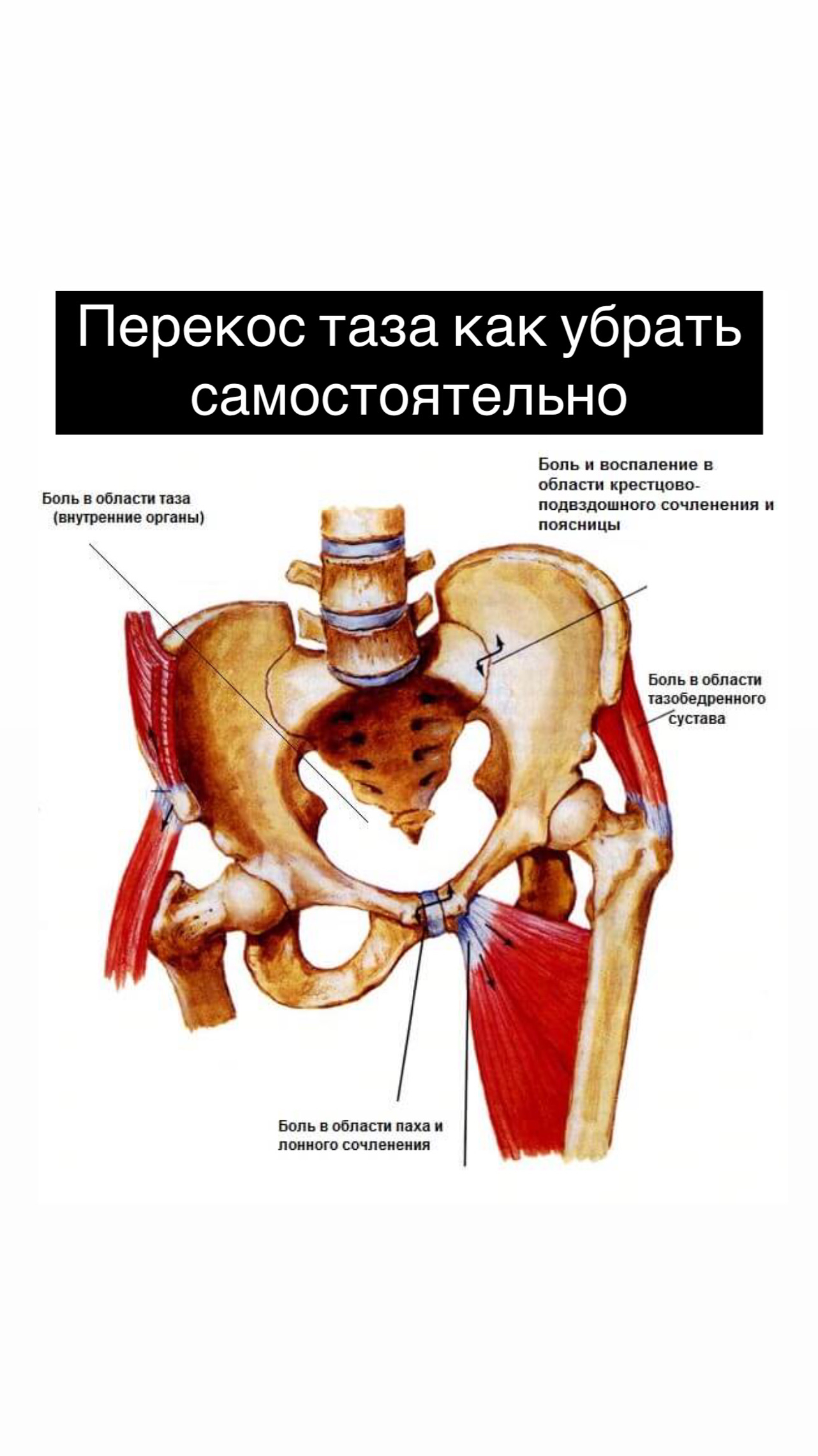 ПЕРЕКОС ТАЗА: как убрать самостоятельно.