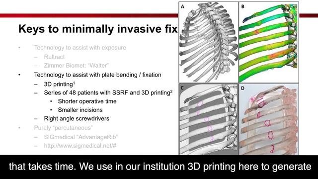 Minimally Invasive Approaches to Rib Fracture, Harvard Innovations in Chest Wall Surgery