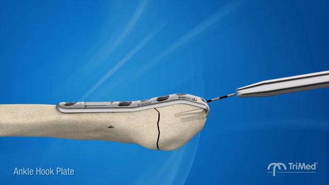 Weber A fracture care - Treating lateral malleolus fractures with TriMed Ankle Hook Plate