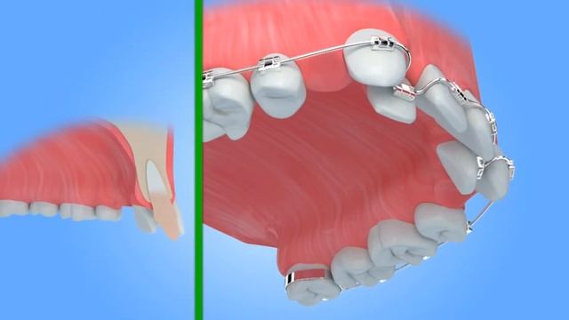 Как ставят брекеты