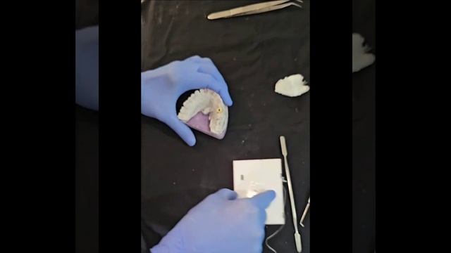 Cement retained to screw retained crown using Relyx U200 by Dr Alaap shah MDS