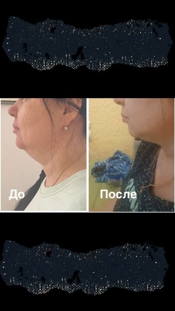 Криолиполиз подбородка