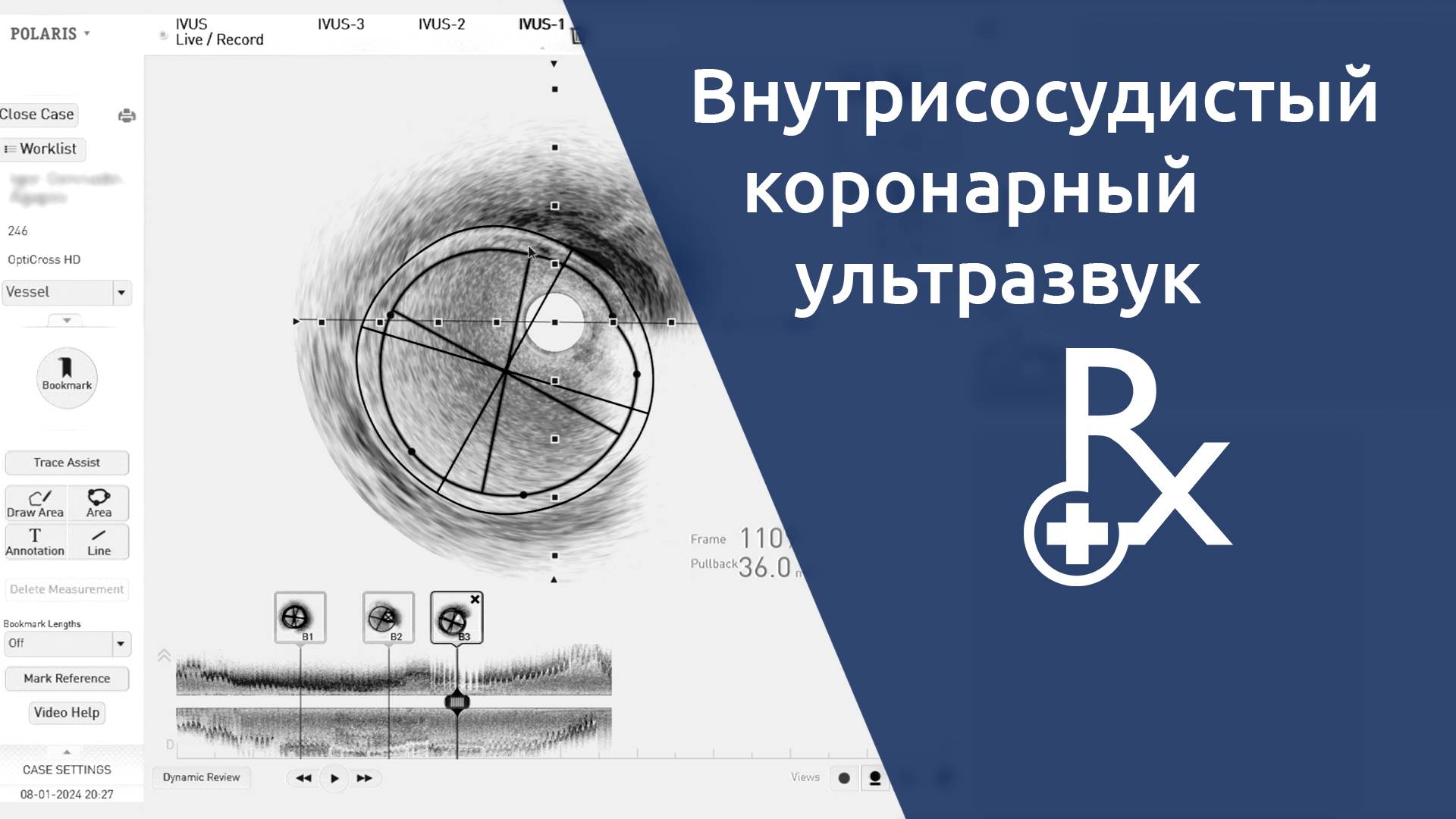 Стентирование коронарной артерии при поддержке внутрисосудистого ультразвука