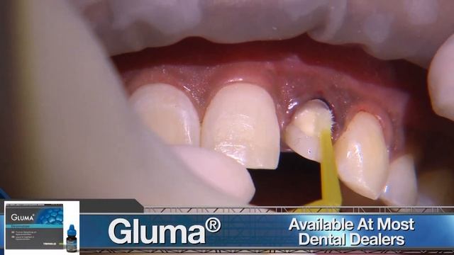 HOW TO Place #BruxZir Esthetic on Teeth #7 & #10