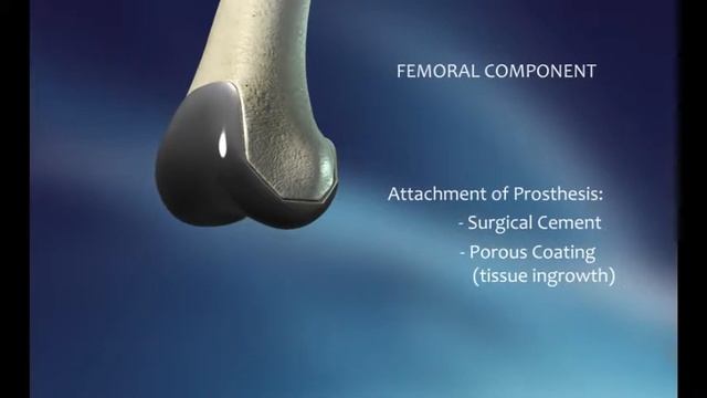 knee implant movie