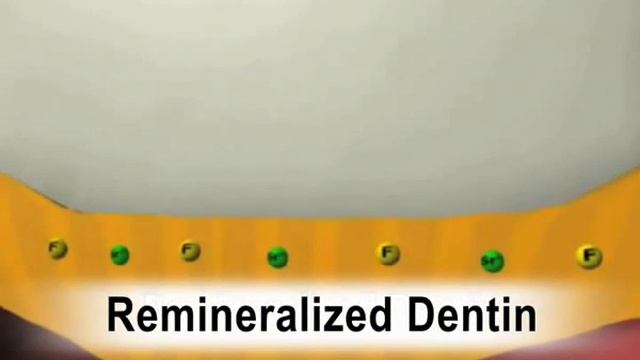 3D Glass Ionomer Animation