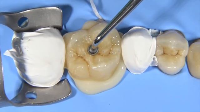 Onlay luting with G CEM LinkForce dual cure resin cement by Dr  J  Tapia Guadix