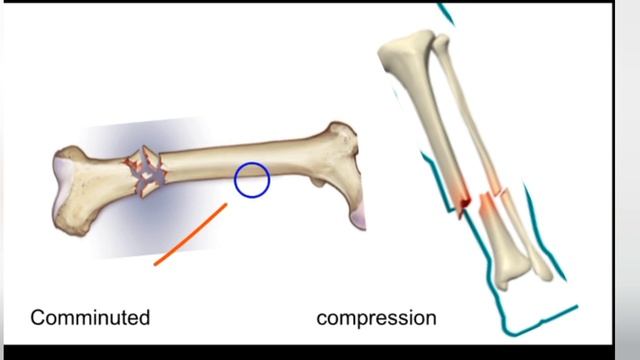 भग्न और संधिमोक्ष | fracture and dislocation | shalya tantra | BAMS | AyurMedical Classes |