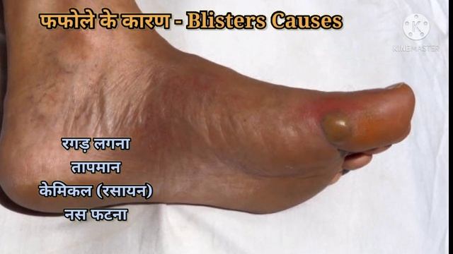 फफोला (तरल पदार्थ से भरा हुआ त्वचा का एक उभार) || Blisters explained in Hindi || Medhealth support