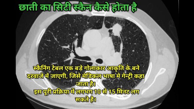 छाती का सिटी स्कैन क्यों और कैसे किया जाता है, इससे क्या पता चलता है? || Chest ct scan in Hindi
