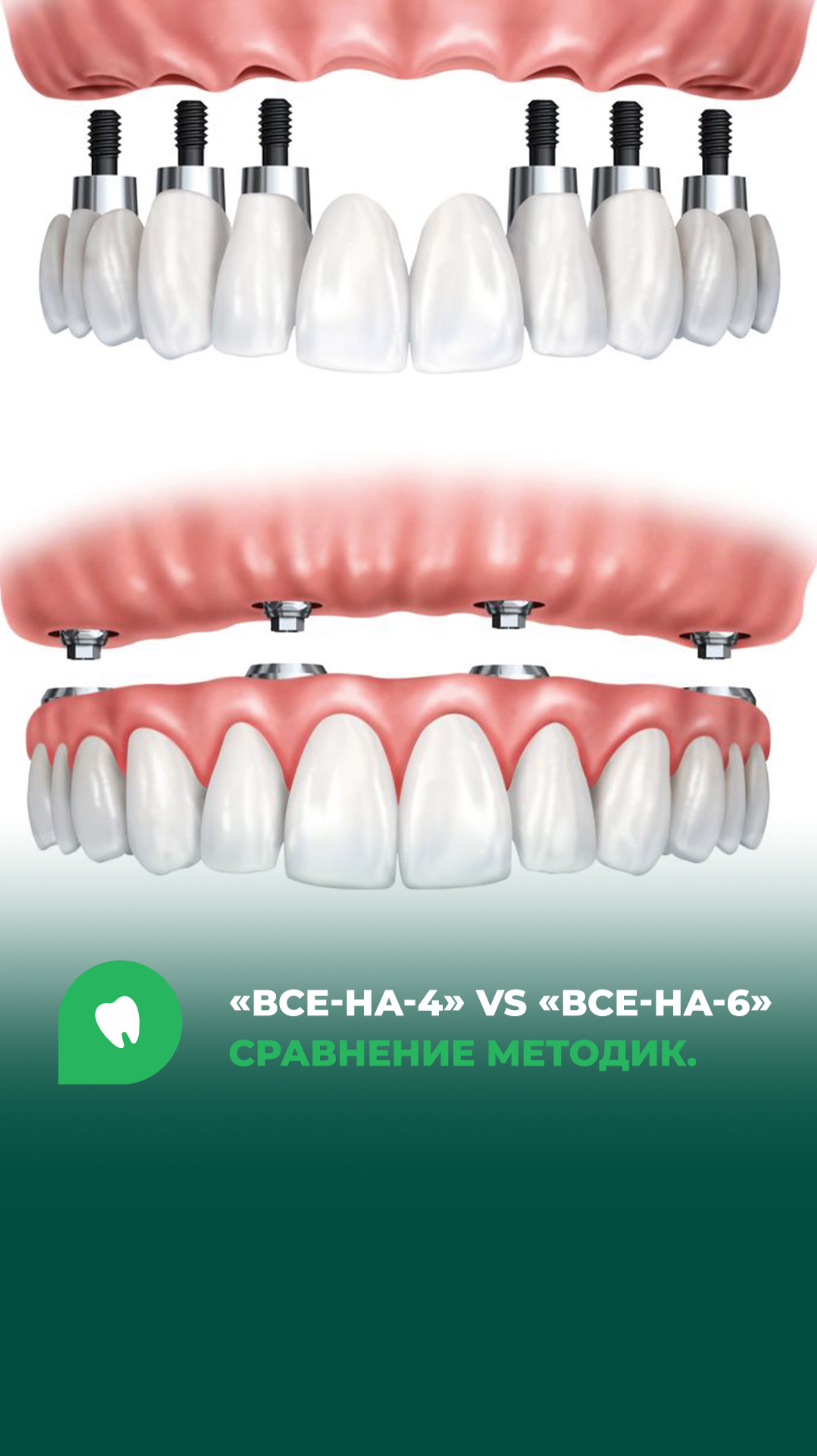«Все-на-4» и «Все-на-6» применяются для восстановления полного зубного ряда, но имеют различия.