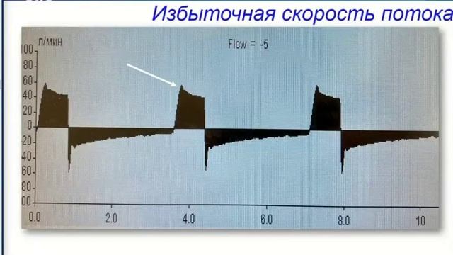 Асинхронии при ИВЛ Корякин А.Г. ЖКС 2022