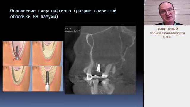 Пажинский ЛВ. Одонтогенный синусит