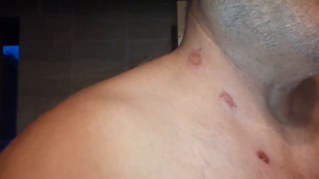 Веррукацид подействовал)))))