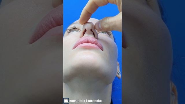 Ринопластика.
В конце смотрите результат операции
