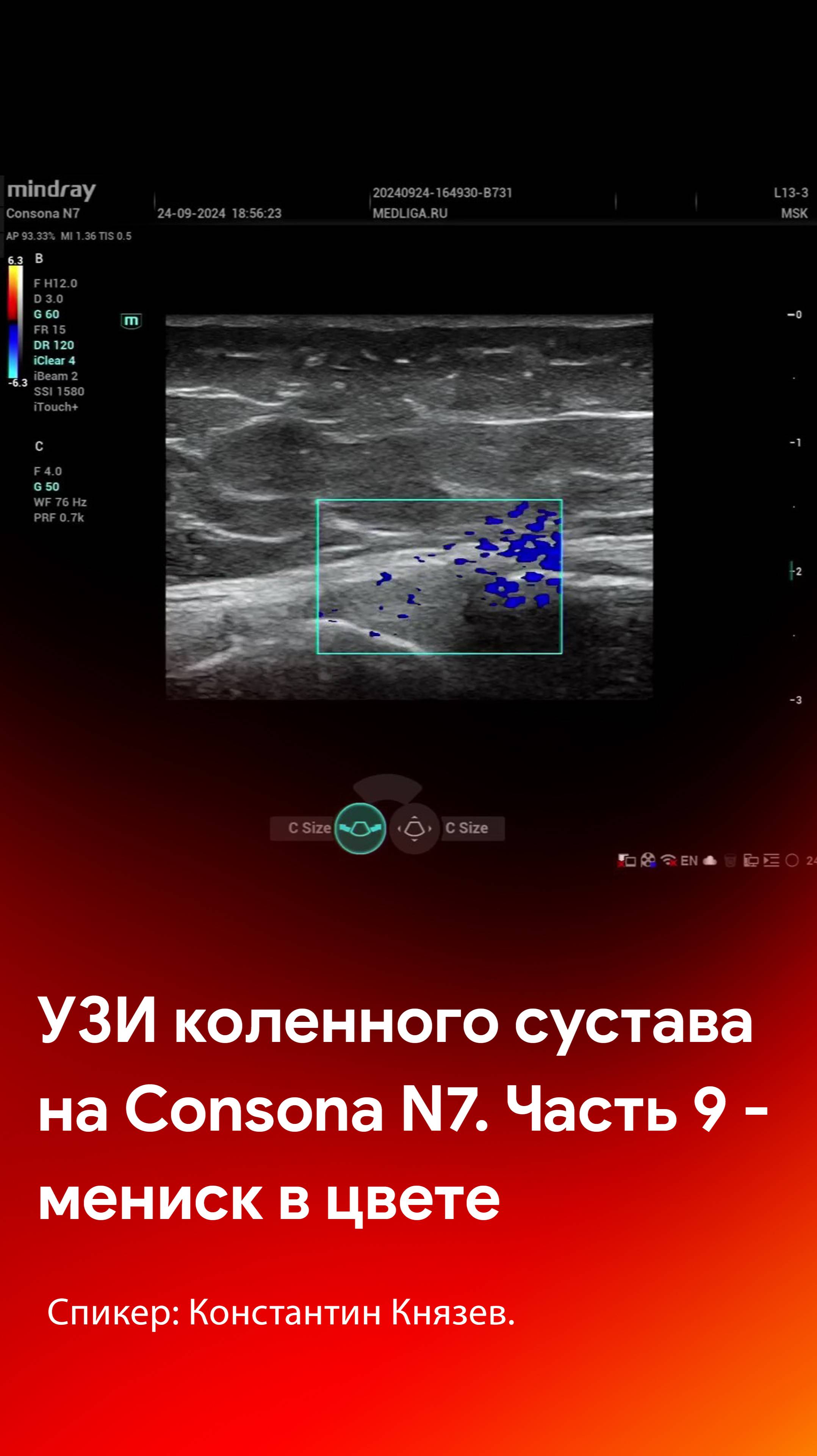 УЗИ коленного сустава на Mindray Consona N7. Часть 9 - мениск в цветовом допплере