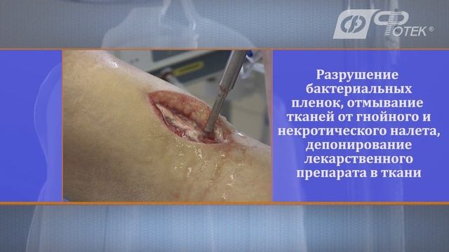Аппараты ультразвуковые кавитационные ACTITON и ACTITON-A в гнойной хирургии