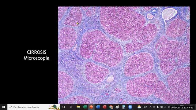 Patología Especial - Patología del Tubo Digestivo Parte 2 1/1
