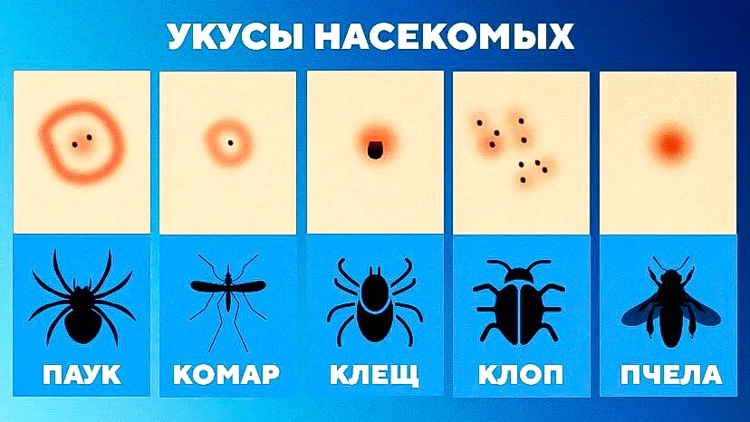 КАК РАСПОЗНАТЬ УКУСЫ РАЗНЫХ НАСЕКОМЫХ? И КАК ПОСТУПИТЬ В КАЖДОМ СЛУЧАЕ.Укусы клопов, блох,комаров