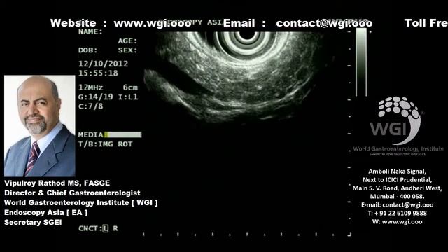 Pancreatic neoplasm in pancreatic body - detected and diagnosed with EUS guided FNA