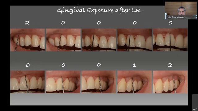 Management of a “Gummy Smile”.  A multidisciplinary approach for an aesthetic and natural smile