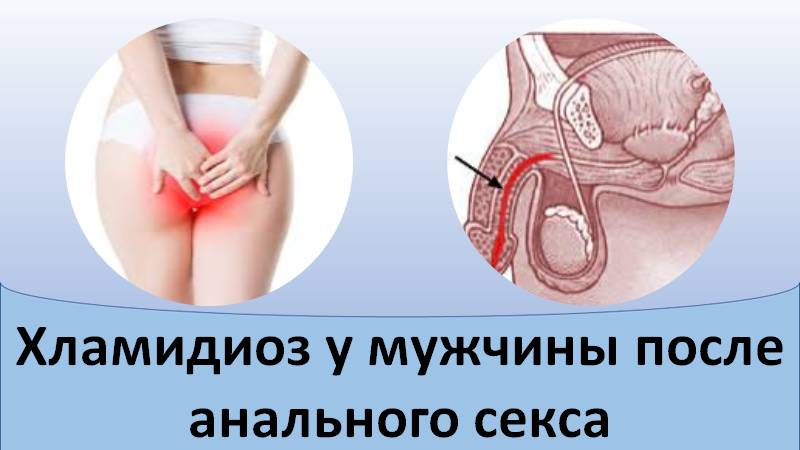 Хламидиоз у мужчины после анального секса