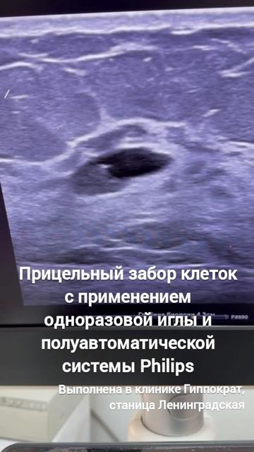 Пункционная биопсия кисты молочной железы