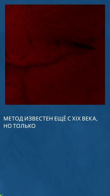 Лечение варикозных вен нижних конечностей внутривенными инъекциями солевого раствора