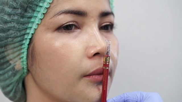 Treatment Filler di Natasha Skin Clinic Center