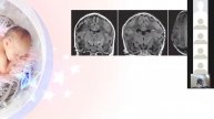 PVL AND WHITE MATTER INJURY IN PRETERM