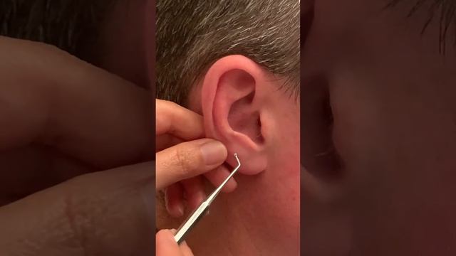 Class 2 CAM Antitragus