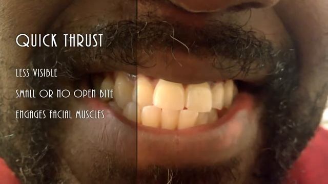 Tongue Thrust Evaluation
