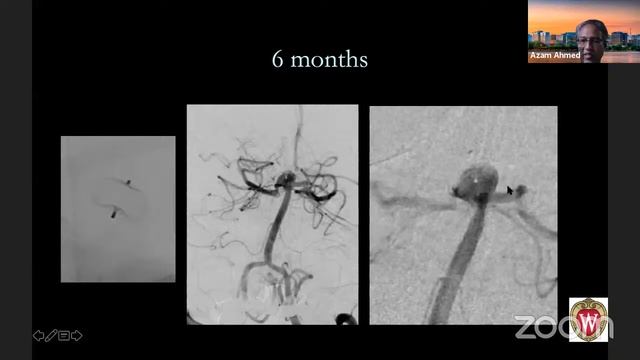 Webiinar # 38 - Advances in Vascular Neurosurgery