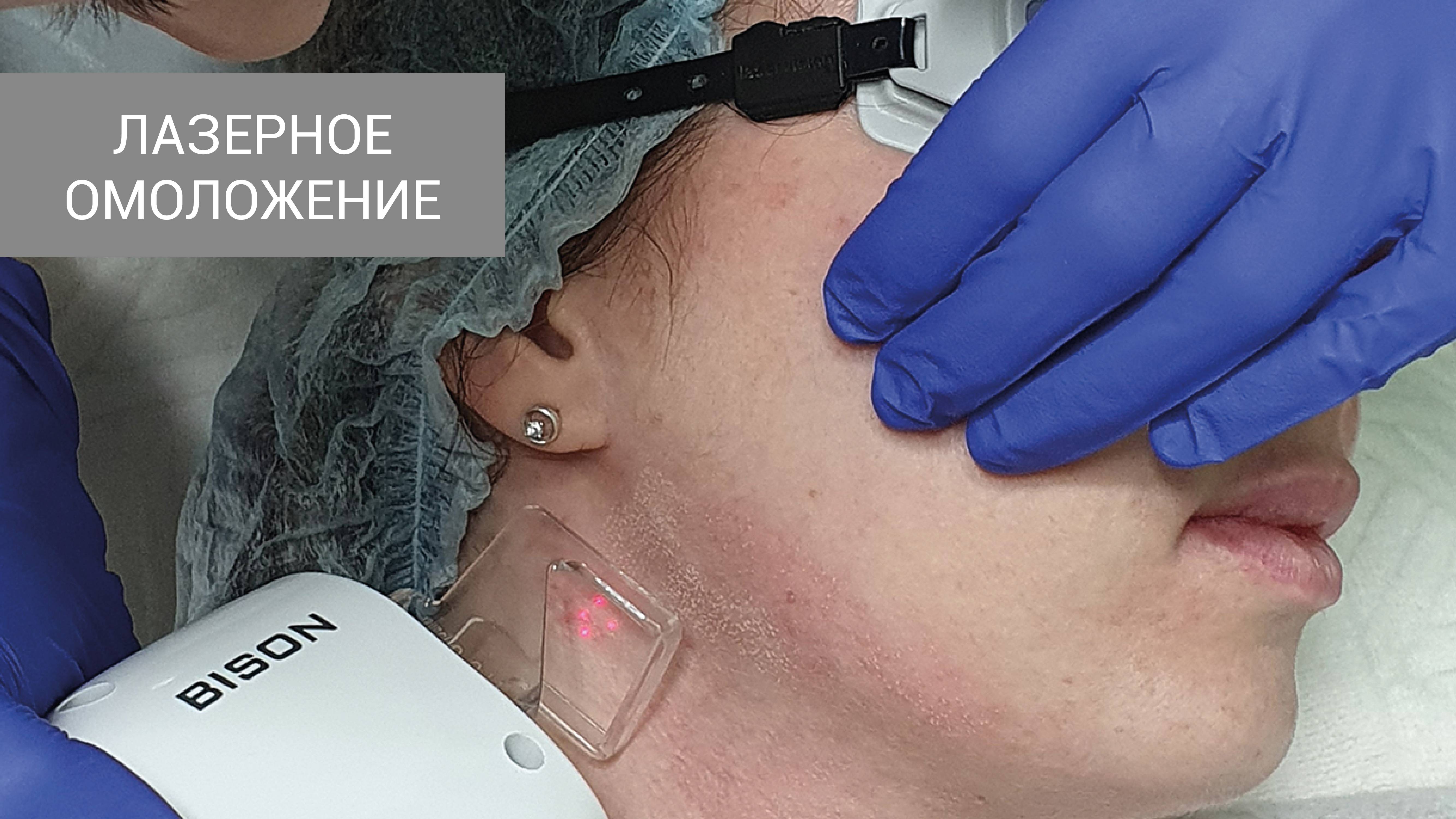 Лазерное омоложение в клинике Артевита