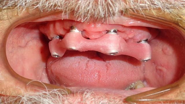 "All on 4" Full Zirconia Arch Procedure Protocol