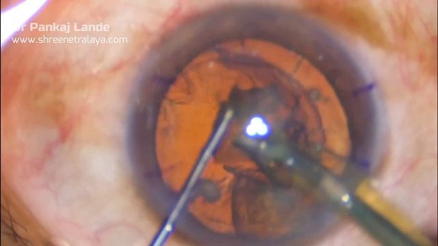 Phaco with LRI (Limbal Ralaxing Incisions) for astigmatism- Dr PL