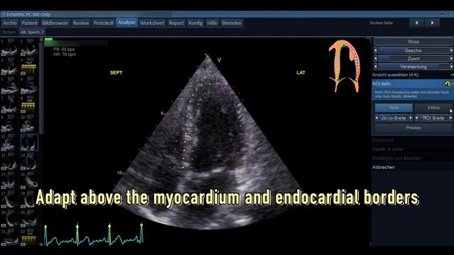 〖Echocardiography〗 Strain Imaging 2 - ROI & Interpretation