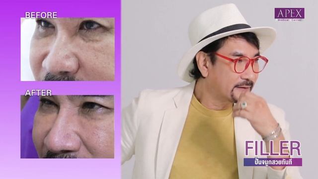 APEX รวมรีวิวฉีดfiller จมูก ดั้งสวยเข้ากับรูปหน้า