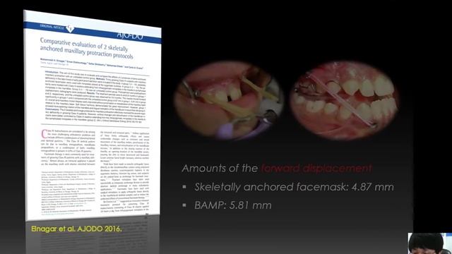 CBCT Superimposition Using Open-Source Softwares (ITK-SNAP; 3D Slicer)