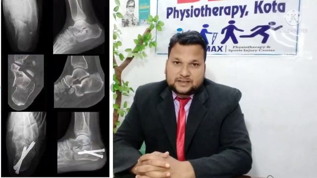 Calcaneus Fracture Recovery Time | Heel Fracture treatment | heel Fracture Recovery | in Hindi