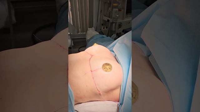 Уменьшение груди с подтяжкой.