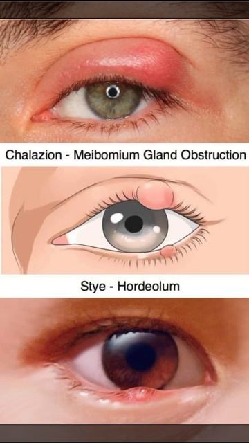Chalazion!!Stye!!!Dr Gohar Shahroz #doctor #short #shortsvideo