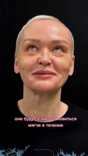 Месяц после круговой блефаропластики