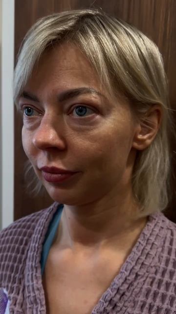 Круговая блефаропластика. 

Результат спустя 2,5 месяца после операции