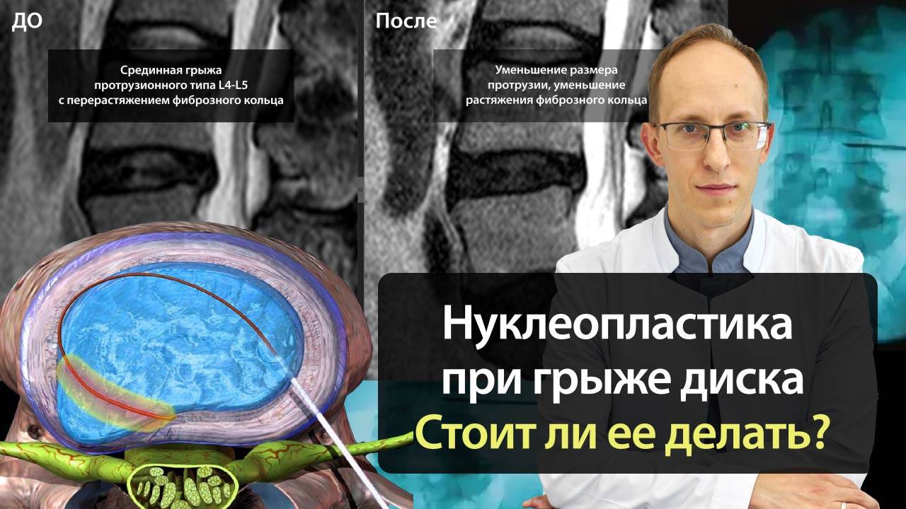 Насколько эффективна нуклеопластика при грыже диска? Безопасна ли она? Стоит ли ее делать?